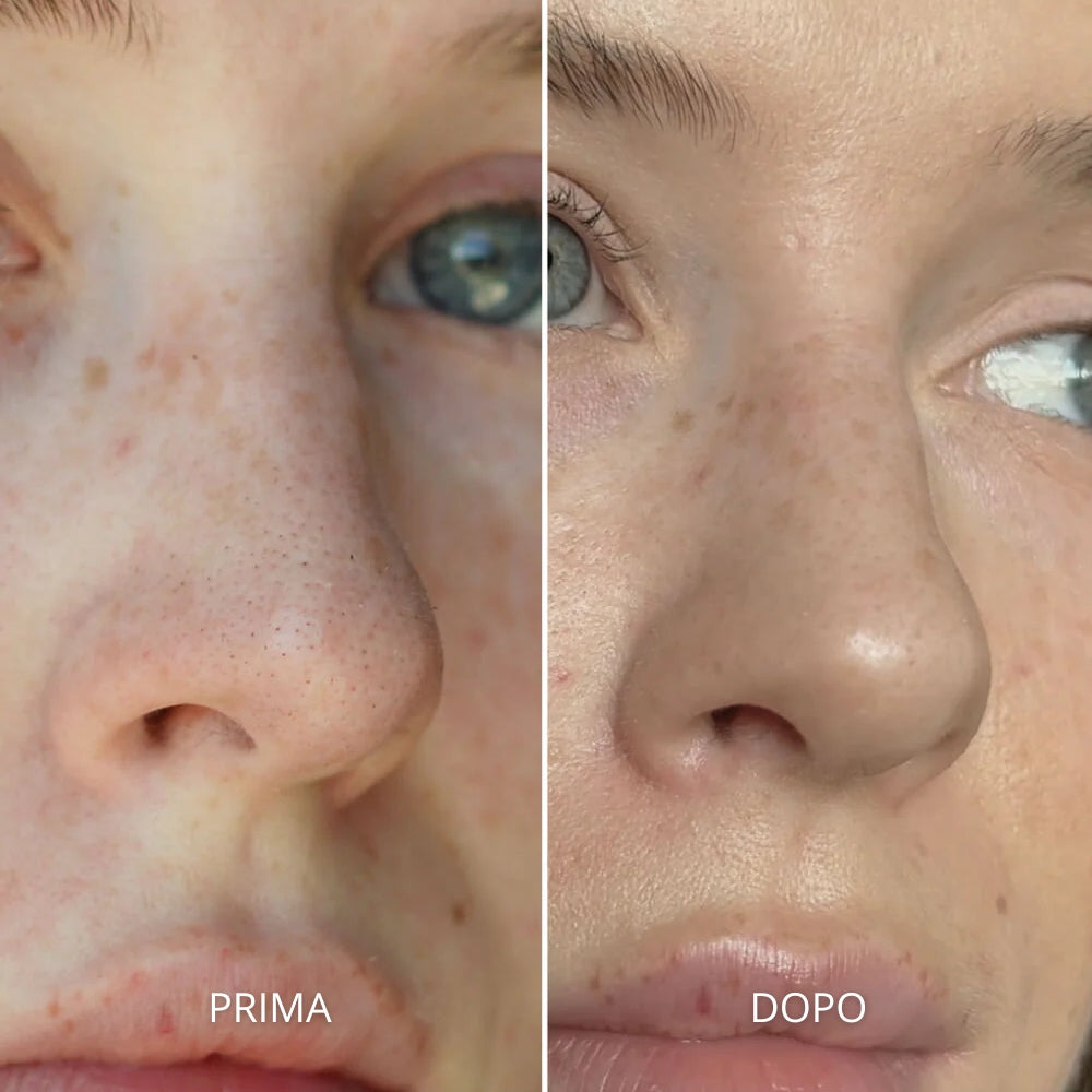 Nose Patches - Cerotti Nasali